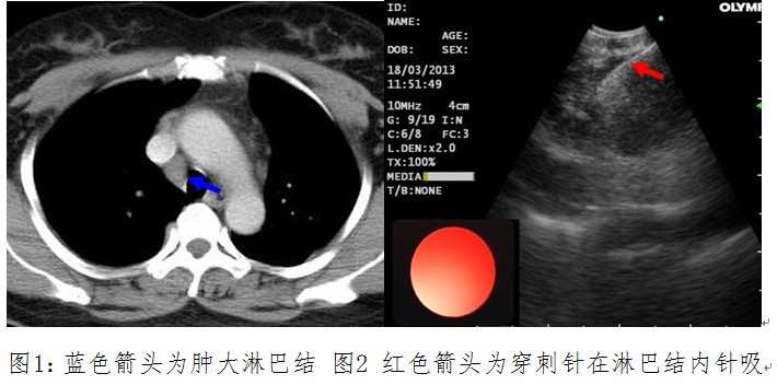 我院呼吸科开展首例超声电子支气管镜检查